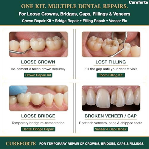 Zinc Oxide Eugenol Dental Cement Kit – Professional Temporary Crown & Bridge Glue for Tooth Fillings | Self-Curing, Strong Bond, and Pulp-Soothing Formula | Easy-to-Use Dental Repair Kit