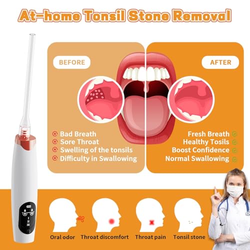 Electric Tonsil Stone Remover Vacuum，Tonsil Stone Removal Kit, 5X Magnifying Glass & LED Light, with Cleaning Syringe, Tongue Depressor, Straight/Curved Glass Tubes, Painless Removal and Fresh Breath