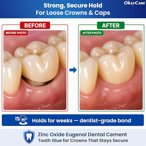 Zinc Oxide Eugenol Dental Cement Kit – Instant Tooth Repair, Cap, Crown & Bridge Filling | Ultra Strong & Pulp-Soothing Formula | Long Lasting - Easy Mix-and-Use Dental Adhesive for DIY, Home & Clinic