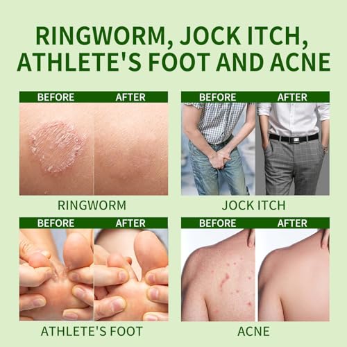 Tuymec Antifungal Bar Soap - Skin Fungus Treatment for Athlete’s Foot, Jock Itch & Ringworm - Medicated Anti Fungal Skin Soap with Clotrimazole 1% (Tea Tree, 2 Bars, 1 Case) Tea Tree