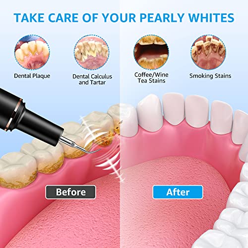 Plaque Remover for Teeth - Tartar Remover for Teeth with Dental Tools Black