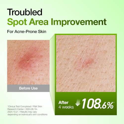 Anua Azelaic Acid 10 Hyaluron Redness Soothing Serum, 1.01 fl oz | Facial Serum for Blemish-Prone & Oily-Prone Skin, Lightweight & Hydrating Blemish Care, Hyaluronic Acid, Korean Skincare 1.01 Fl Oz (Pack of 1)