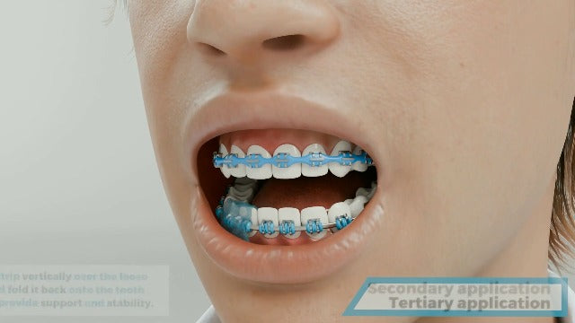 Chillin Strips, Therapeautic, Moldable and Dissolvable Strips, Replaces Orthodontic Wax for Braces, Dentures, Dental Appliances, 2+ Hours of Oral Pain Relief, Icy Cocoa, 6 Strips