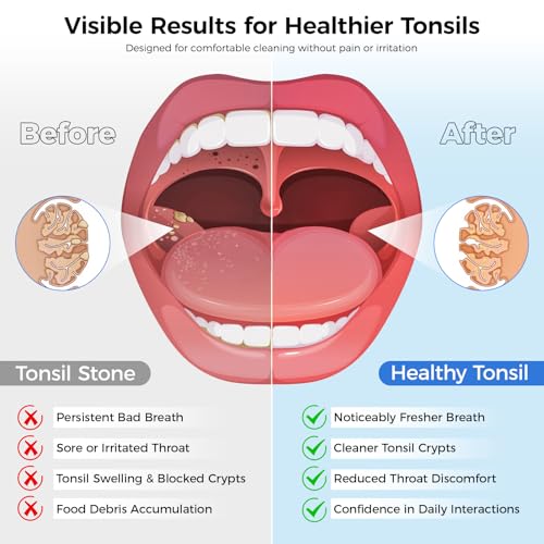Tonsil Stone Remover Kit, Upgraded Rechargeable Tonsil Stone Vacuum with LED Light & Saliva Reservoir, Best Fast Painless Tonsillolith Removal Tool, Fight Bad Breath, Safe Silicone & 11 Attachments Blue