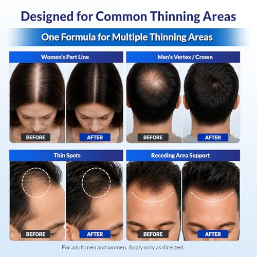 Minoxidil for Men and Women Extra Strength: Minoxidil 5% Topical Solution for Hair Regrowth Treatment for Hair Loss & Thinning Hair - Liquid Formula with Dropper Applicator