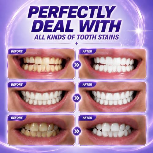 Purple Teeth Whitening Strips V34 Pap+ 15 Treatments 30 Strips Teeth Professional Brightening Removes Stains in 30 Minutes Safe for Enamel Non Sensitive Teeth Whitening 15 Count (Pack of 1)