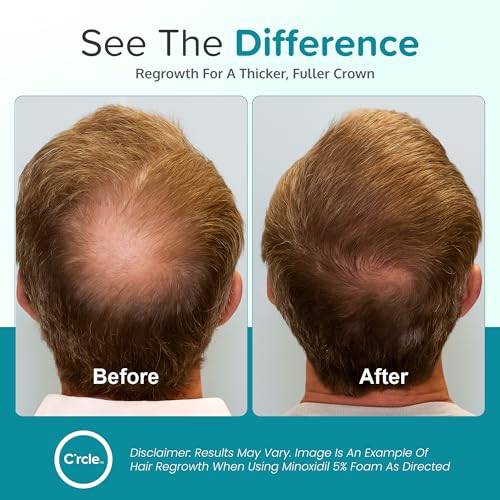 Minoxidil for Men Foam 5%, Unscented 3 Month Supply, Supports Hair Regrowth 2.11 Count (Pack of 3)