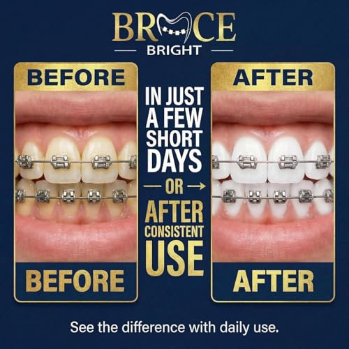Teeth Whitening for Braces, Braces Cleaner Foam, Brace Teeth Whitening kit for Under Metal, Ceramic, Brackets & Wires. Use w/Toothbrush or Trays No Sensitivity. Minty, Teens, Adults, Refill 2 Pack Bracebright Refill 2 Pack
