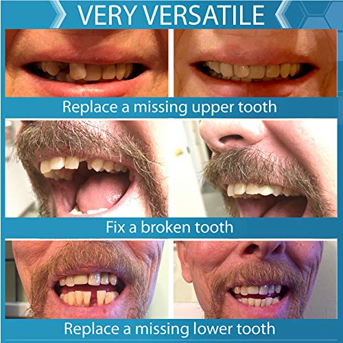 Instant Smile Complete Your Smile Temporary Tooth Replacement Kit - Replace a Missing Tooth in Minutes - Patented 40 Piece Assortment