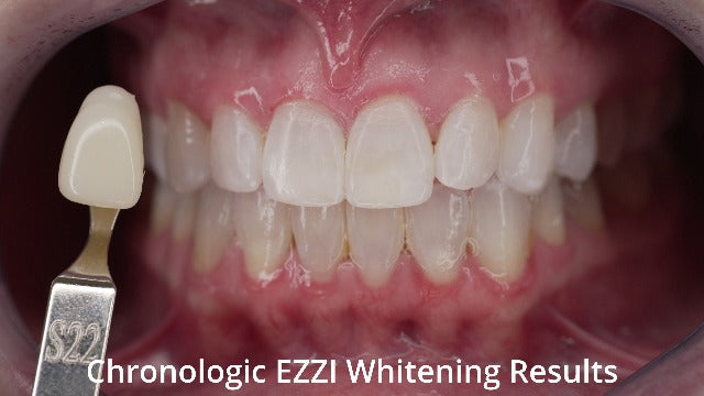 EZZI Teeth Whitening Kit | Fast Whitener Gel 44% Carbamide Peroxide | for Discolored, Yellow, Brown, Black, Coffee, Smoking, Intrinisic Deep Stains