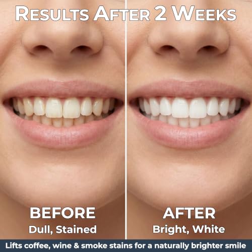 Teeth Whitening Strips for Sensitive Teeth, 28 Treatments, 56 Count 56 Count (Pack of 1)