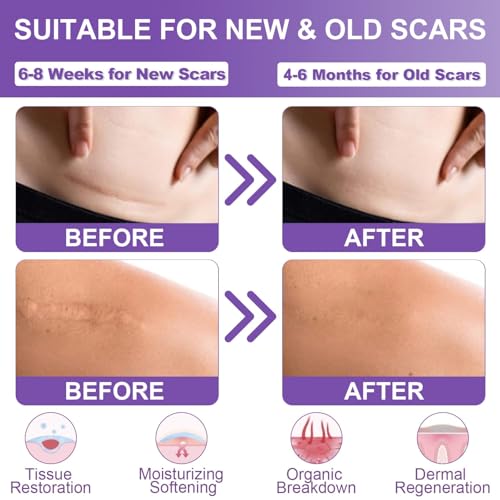 Silicone Scar Sheets, Medical Grade Silicone Scar Tape (1.6" x 120"), Professional Scar Removal Treatment, Reusable, for Healing Keloids, Surgeries Scars, C-sections, and Burns 1.6" x 120"
