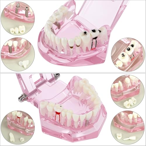 QWORK Dental Implant Teeth Model #2001 Typodont Restoration Pink – Detailed Fixed Prosthetic Study Aid for Dental School Education, Patient Consultation & Training