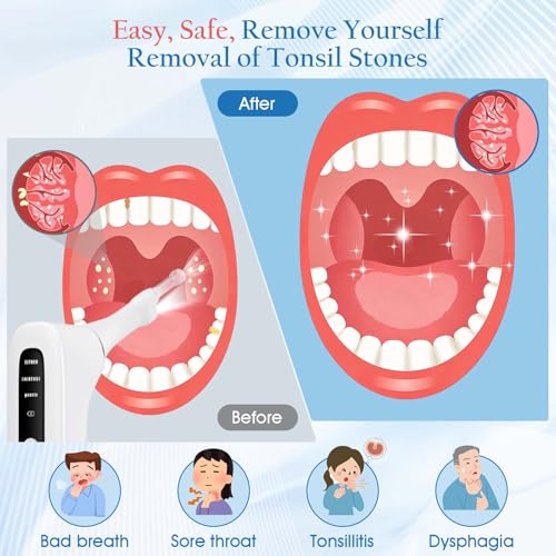 Upgraded Electronic Tonsil Stone Remover with 3-Speed Vacuum & LED Light