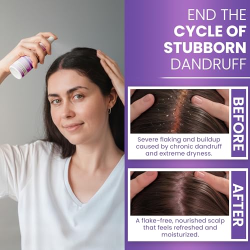 Neoketramin Anti Fungal Scalp Spray for Dandruff, Psoriasis & Folliculitis