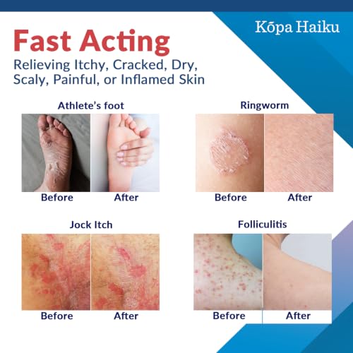 KOPA HAIKU Antifungal Cream: Treatment for Ringworm, Athlete’s Foot & Jock Itch, Perioral Dermatitis & Seborrheic Dermatitis 1 oz 1 Ounce(Pack of 1)