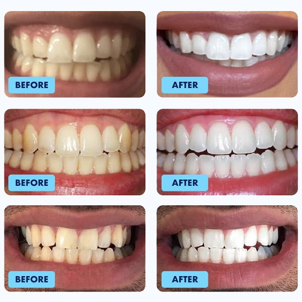 Glimmer Teeth Whitening Kit - LED Light, 35% Carbamide Peroxide, (3) 3ml Gel Syringes, (1) Remineralization Gel, and Tray - BeesActive Australia