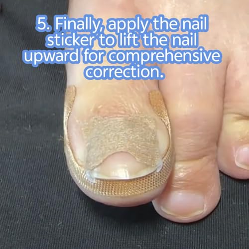 Ingrown Toenail Corrector Kit - Professional Painless Correction Strips & Pedicure Tools for At-Home Care