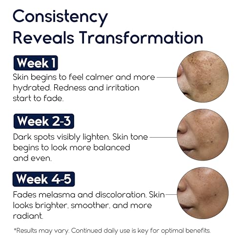 Melasma Treatment for Face - Melasma Cream & Age Spot Remover for Skin Discoloration, Post-Blemish Marks, Scars & Spots | Dark Spot Remover for Face & Body