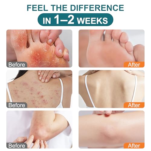 Antifungal Cream for Jock Itch, Athlete’s Foot & Ringworm – 1% Clotrimazole Cream, Relieves Burning, Scaling, Itching & Cracking, Ringworm Treatment for Humans (3.5 Ounce) 3.5 Ounces