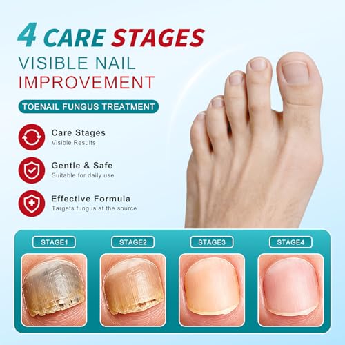 Nail Fungus Pen : Toenail Fungus Treatment Extra Strength - Antifungal Nail Repair for Damaged, Yellow, Thick Toenails - 25% Undecylenic Acid & Tea Tree Oil Mild and Non-Irritating 3pieces