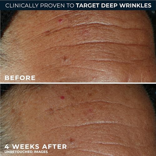RoC Derm Correxion Fill+Treat Retinol Serum, Deep Wrinkle Filler for Face