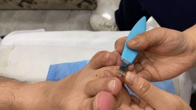BEZOX Ingrown Toenail Removal Blades and Foot Callus Knife - 3 Different Blades Pedicure Knives with Toenail Lifter and Thick Nail File - Blue