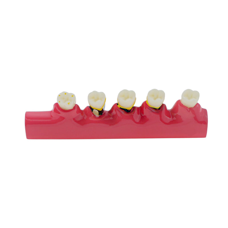 Dental Teeth Model 6-Stage Periodontal Disease Demonstration Model for Dental Education - BeesActive Australia