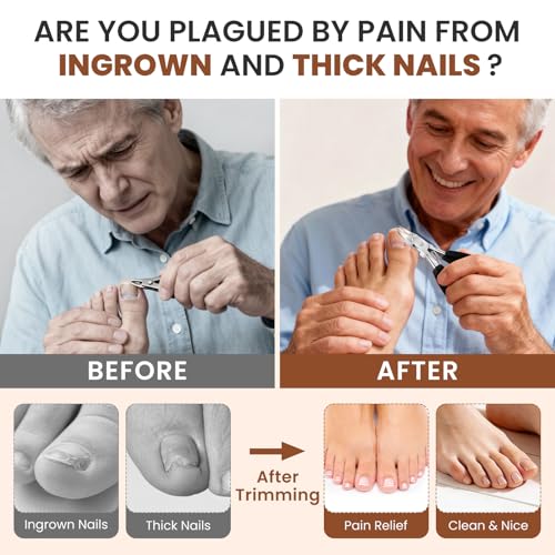 LIONVISON Ingrown Toenail Removal Kit: Thick Toenails in 3S & 70% Faster