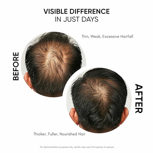Masofta Hair Growth Serum For Density, Hair fall Control with 3% Redensyl, 5% Capixyl, 4% Anagain, 3% Procapil & 3% Baicapil, Rosemary & Biotin For Both Men & Women, 1.01 fl.oz./30ML 1.01 Count (Pack of 1)