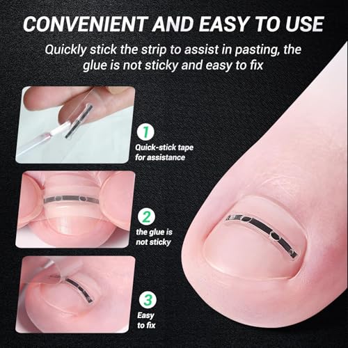Titanium Alloy Ingrown Toenail Treatment, NailTools, and Ingrown Toenail Removal Kit SpeciallyDesigned for Curved Nail Repair and Ingrown ToenailCorrector (0.59/0.67in) 0.59/0.67in