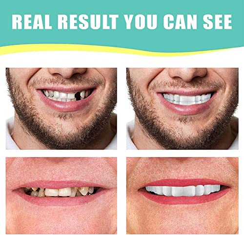 1Set Dentures Veneers Tooth,Dental Care Kits for Anti Molar Orthodontic Cosmetic Teeth,Smile Snap Tooth.(White,1Top+ 1Bottom+2Adhesives+1Tweezers+1Heart-Shaped Storage Box）