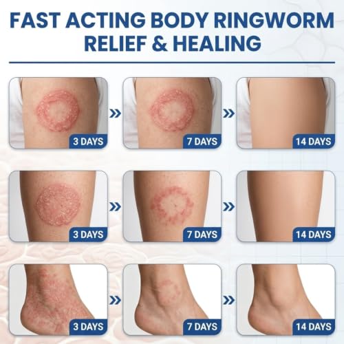 Antifungal Ringworm Treatment Cream, - Miconazole Nitrate 2% Antifungal Cream for Humans - For Fast Itch Relief, Jock Itch & Athlete's Foot - Cream with Ceramides & Tea Tree Oil, Non-Greasy, 3.53oz