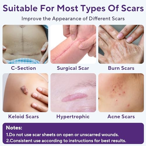 Silicone Scar Sheets, Silicone Scar Tape (1.6"x 60" Roll-1.5m) 1.5M