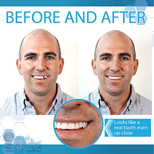 Instant Smile Complete Your Smile Temporary Tooth Replacement Kit - Replace a Missing Tooth in Minutes - Patented 40 Piece Assortment