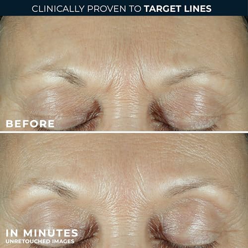 RoC Derm Correxion Fill+Treat Retinol Serum, Deep Wrinkle Filler for Face