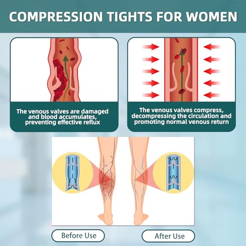 Medical Compression Leggings, 20-30mmHg Graduated Support Stockings Large Footless/Black+beige