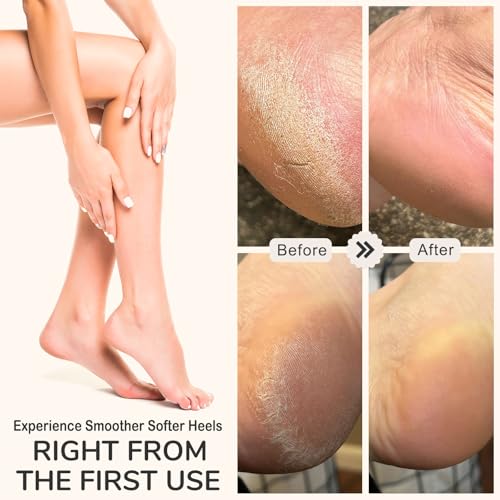 HANMU Dual-Sided Foot File & Toe Callus Remover Set - Durable Foot Scrubber