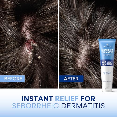 Hermon Seborrheic Dermatitis Scalp Treatment Cream: Soothing Itching Redness Scaling of Seborrheic Dermatitis - Fast-Acting Anti-Itch Ointment for Scalp Face Chest and Body for Men and Women 1 Pack