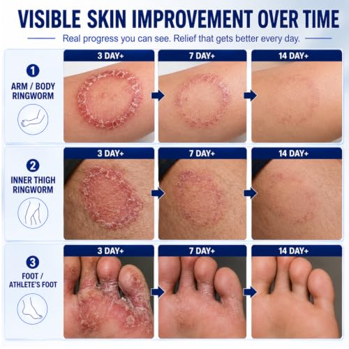 Antifungal Ringworm Treatment Cream, Miconazole Nitrate 2%, 3.53 oz