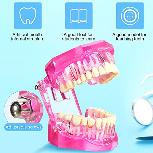 Outus Dental Typodont Model Removable Tooth Implant, Pink, 1 Pcs