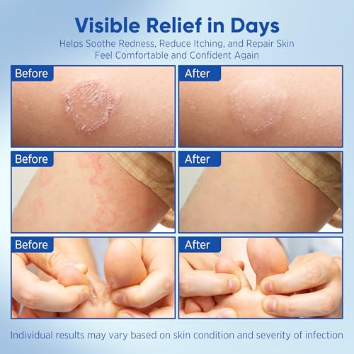 AOSORW Antifungal Cream for Jock Itch - Miconazole Anti Fungal Cream for Itchy Skin Relief Extra Strength - Ringworm Treatment for Humans - Athlete's Foot Treatment - 4.2 oz (120g)