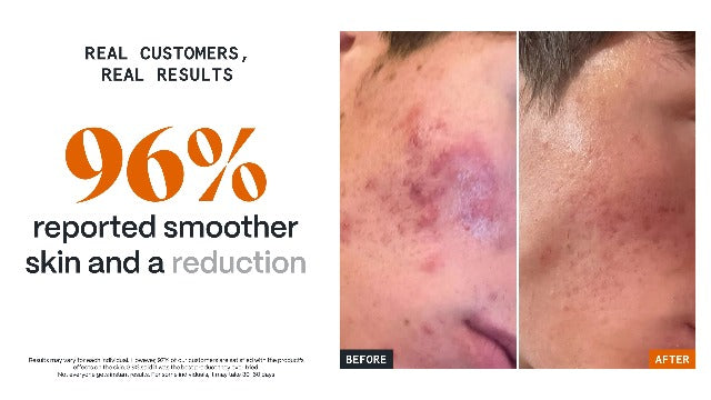 Norse Organics Pimple Scars Balm 2.0 (1 oz)
