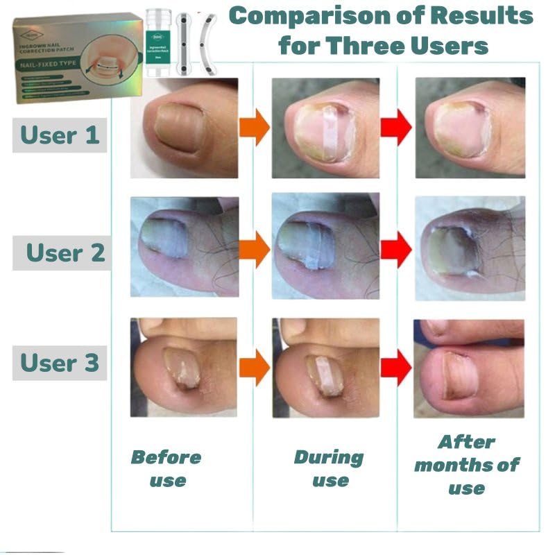 Ingrown Toenail Corrector & Removal Kit - at Home Treatment for Ingrown Toenails, Titanium Alloy Ingrown Toenail Treatment Tools Designed for Curved Nail Repair Suitable for Men Woman (0.59/0.67in)