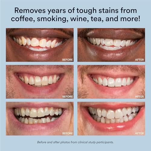 Auraglow Teeth Whitening Kit with LED Light & 35% Carbamide Peroxide Teeth Whitening Gel Refill Pack, 50 Whitening Treatments, Whiten Up to 10 Shades