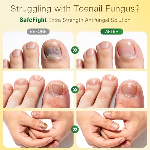 Toenail Fungus Treatment Extra Strength - with 25% Undecylenic Acid - SafeFight Nail Repair Solution for Damaged Nails, Ingrown Nails & Discoloration, 30ML 1 Pack 30ML(1 Pack)