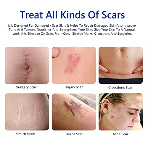 Scar Cream, Scar Removal Cream - Advanced Scar Cream for Surgical Scars, Acne Scars, C-Section, Burns, Stretch Marks -Effective for Old and New Scars Gel Acne Scar Treatment