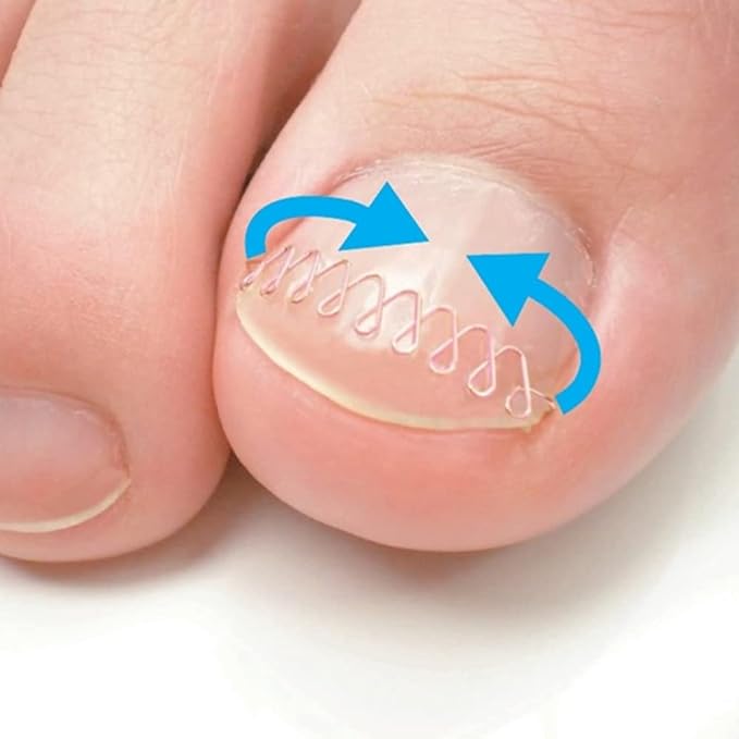 Ingrown nail block set item normal type (M) -  Australia