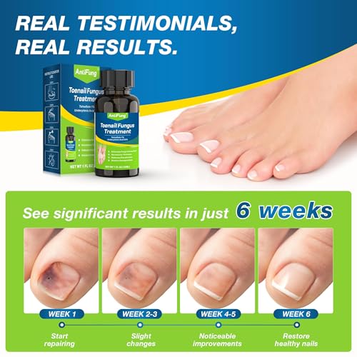 Toenail Fungus Treatment Extra Strength, 25% Undecylenic Acid Care Blue 1 Fl Oz (Pack of 1)