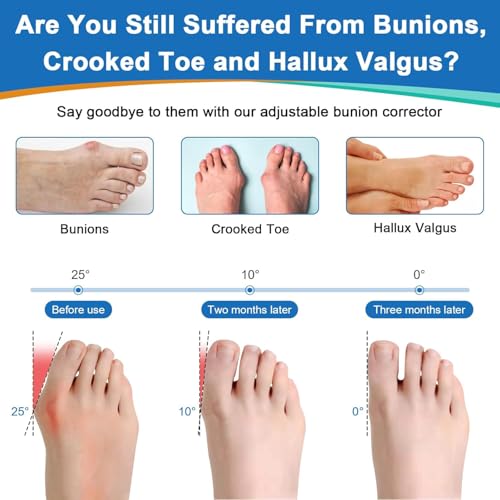 Bunion Corrector for Women & Men, Orthopedic Bunion Splint for left (Black)